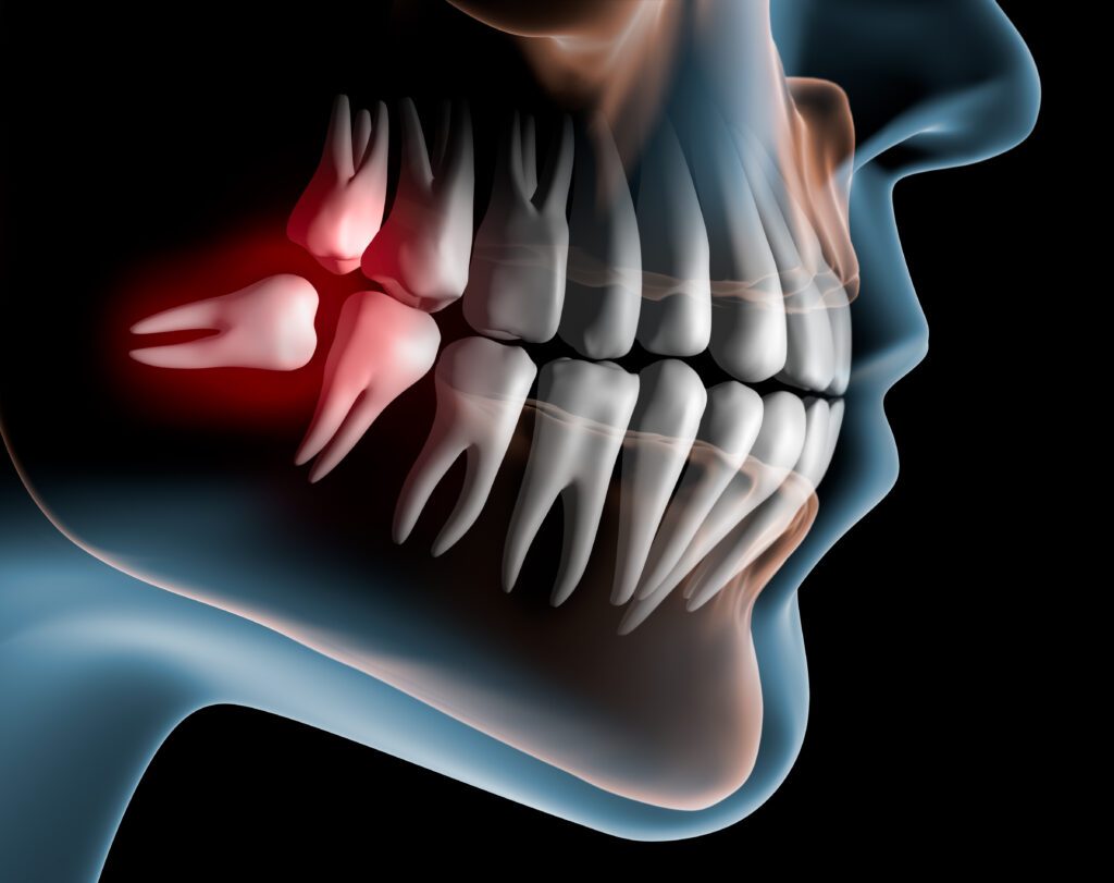 wisdom teeth removal